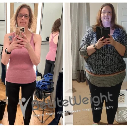 Weight Loss Surgery Gastric Sleeve before and after